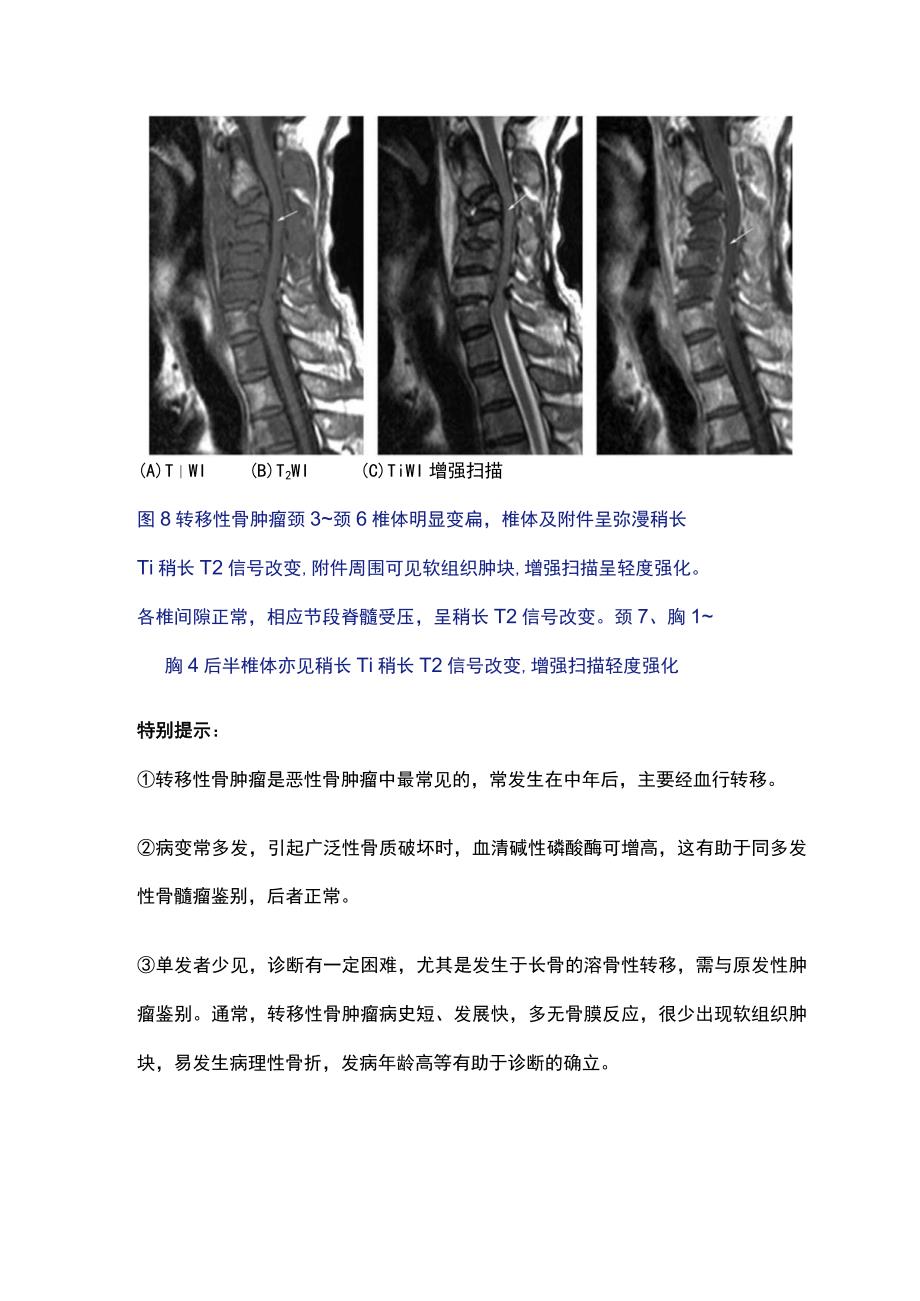 最新：骨肿瘤和肿瘤样病变的MRI诊断（第二部分）.docx_第3页