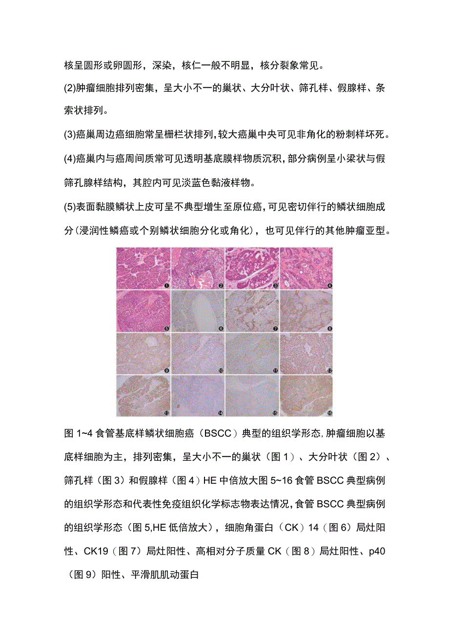 2023食管基底样鳞状细胞癌的临床病理学特征及研究进展.docx_第3页