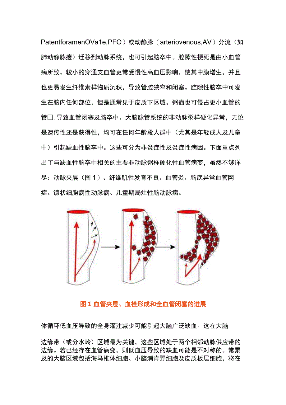 2023缺血性脑卒中的病理生理学.docx_第3页