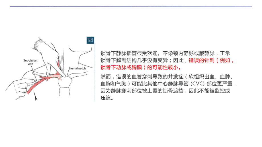 071.锁骨下静脉穿刺术.pptx_第3页