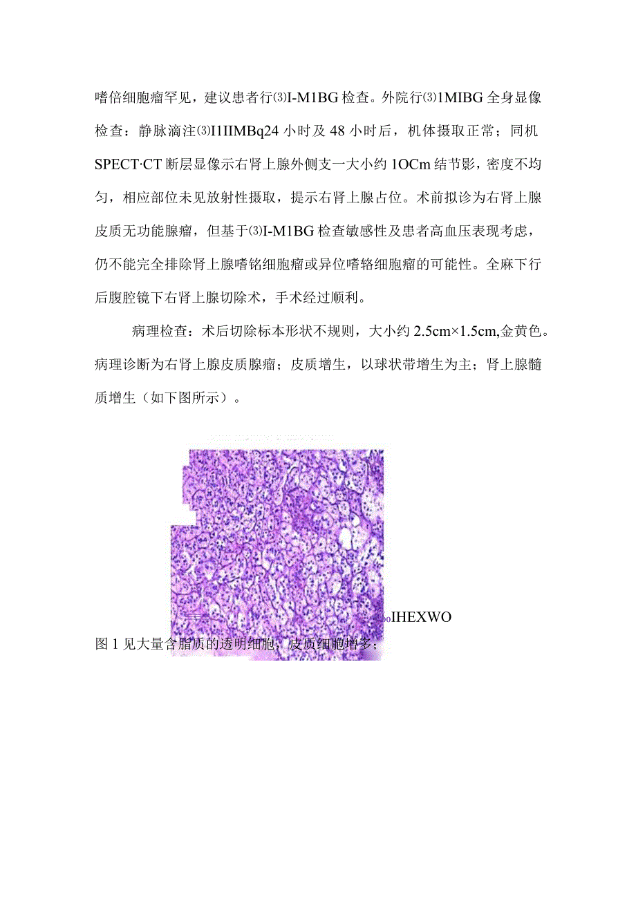 肾上腺皮质腺瘤伴同侧皮、髓质增生一例报告并文献复习.docx_第3页